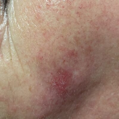 Nordic Formula Benign Skin Cancer