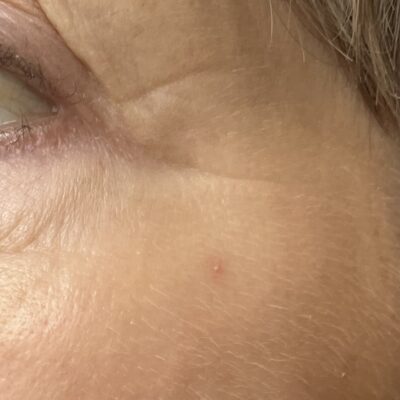 Nordic Formula Lines And Wrinkles