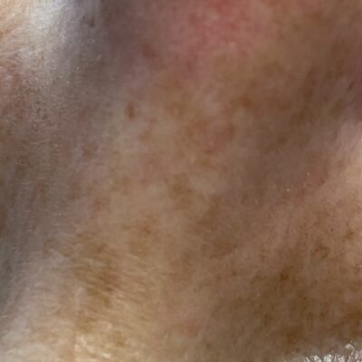 Nordic Formula Pigmentation Spots