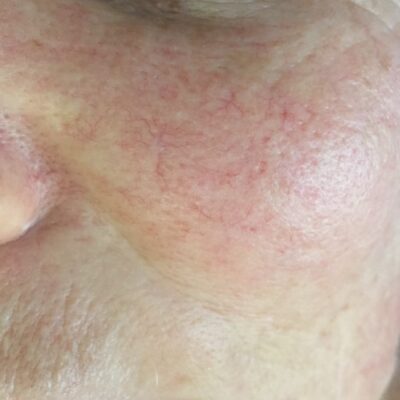 Broken Capillaries